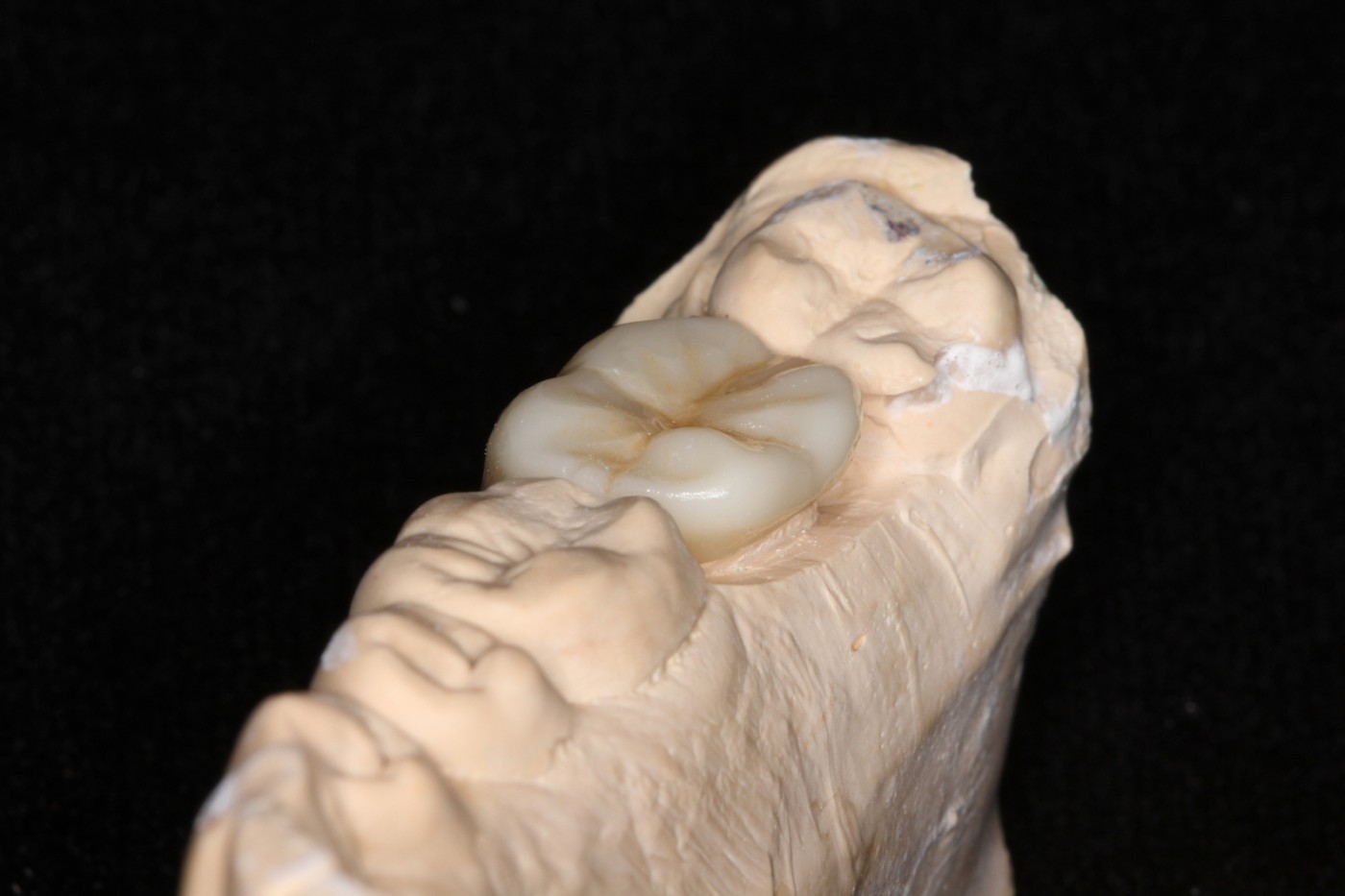 Coroane ceramică suport zirconiu