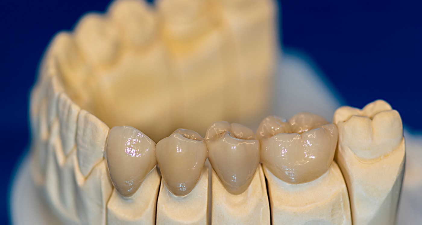 Coroane ceramică suport zirconiu București