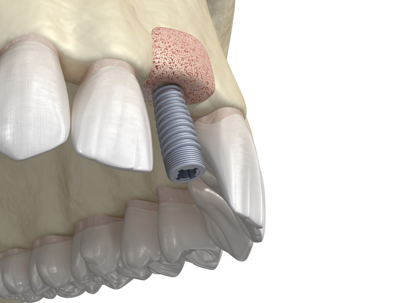 Chirurgie dento-alveolara Clinica Lyrdent Orhideea