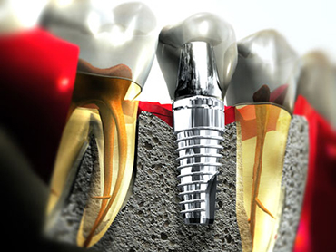 Implant Dentar
