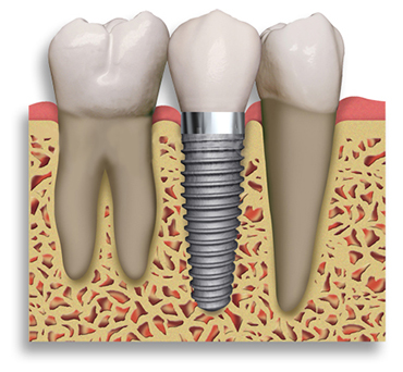 Implant Dentar