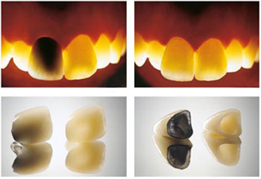 coroana metal in stanga, coroana zirconiu dreapta