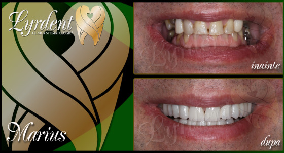coroane ceramica zirconiu